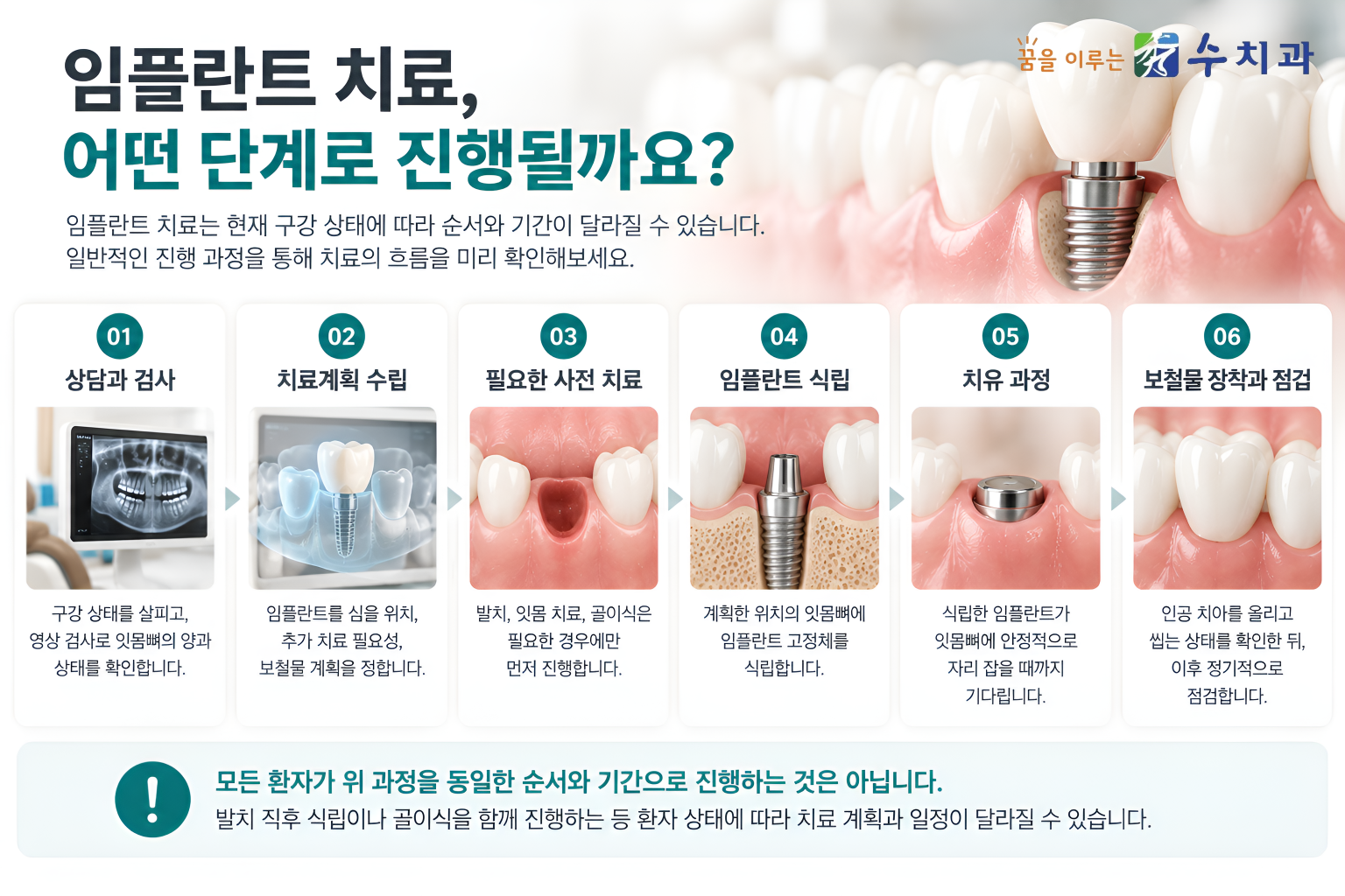 임플란트 치료 6단계 상담과 검사 치료계획 사전 치료 식립 치유 보철물 장착 및 정기점검